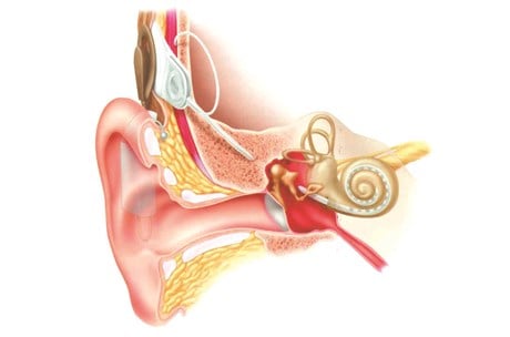 Diagram showing a cochlear implant in place in the ear system.