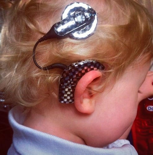 Cochlear implant decorated with race car checks